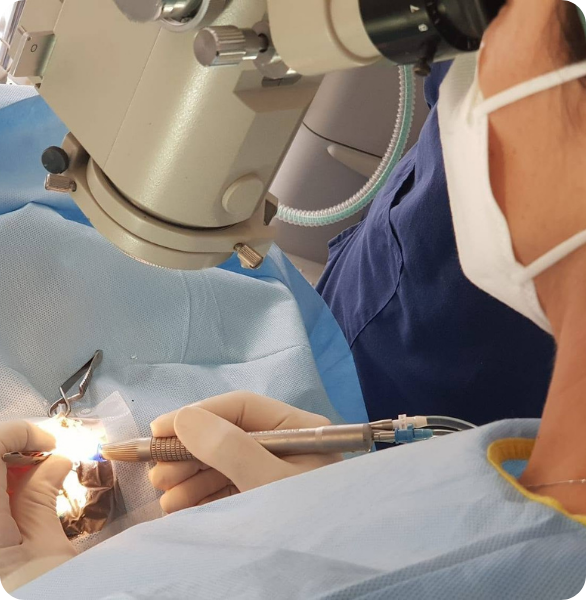 Trattamento di una cataratta