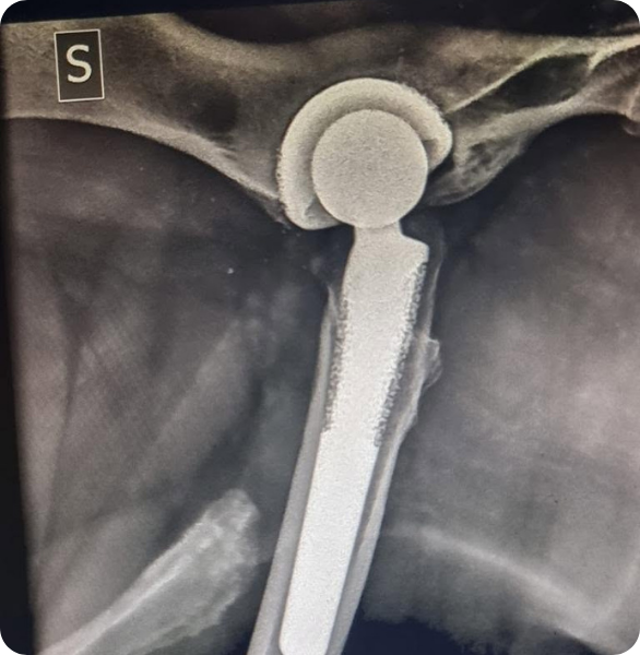 Trattamento chirurgico ortopedico Intervento di Protesi d'anca (THR) radiografato